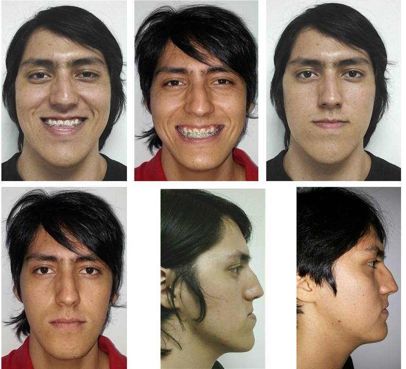Paciente con prognatismo mandibular e hiperdivergencia mandibular (mayor tamaño y posición adelantada y abajo de la mandíbula) con grave afectación estética y funcional. Por medio de la corrección con ortodoncia y cirugía maxilofacial se mejora el perfil facial, la armonía del rostro y se obtiene una oclusión o “mordida” estética y saludable.